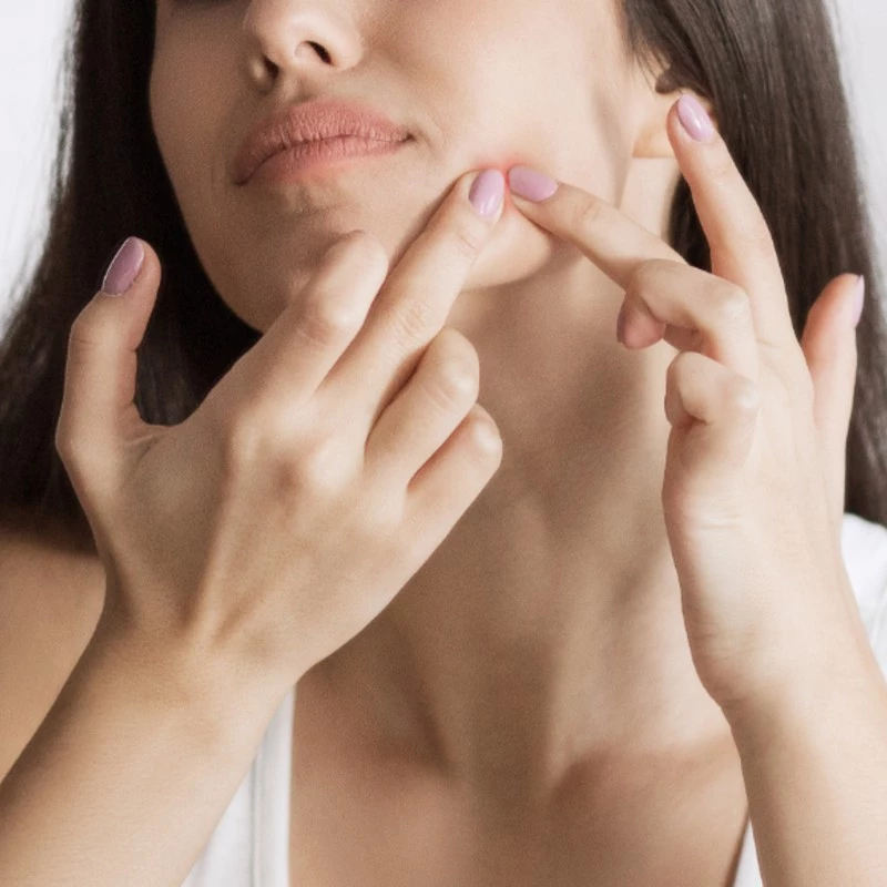 How to treat spots & help prevent scarring